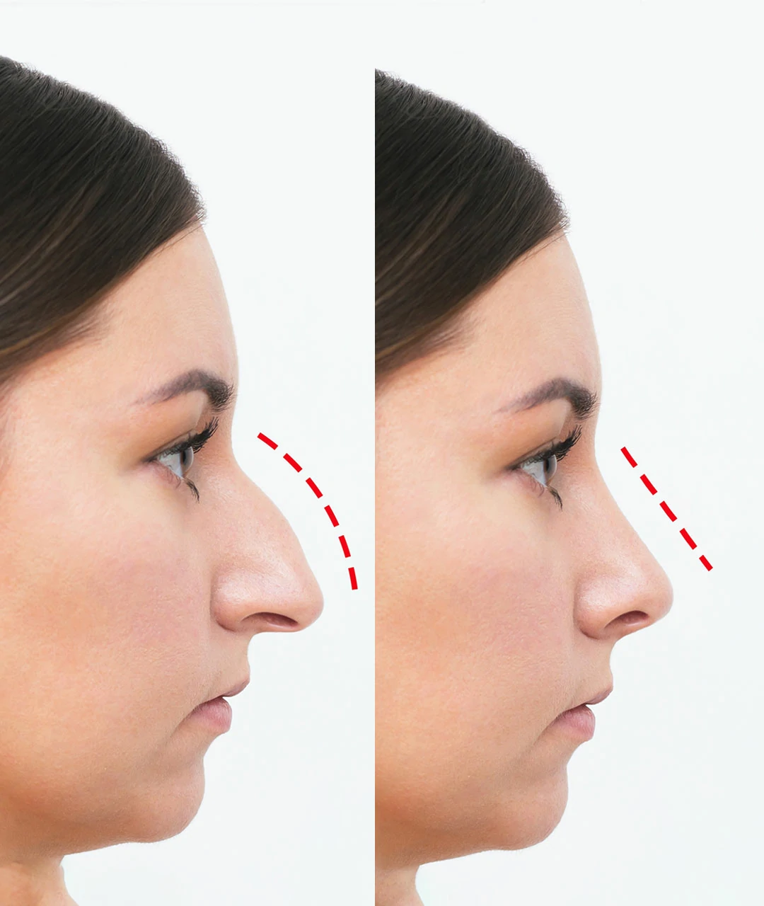 Understanding Different Nose Job Methods Available in Dubai