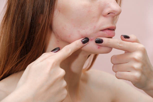 Can Acne Treatment Improve Acne-Prone Skin