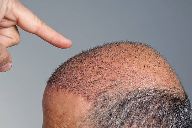 Can FUE Hair Transplant Improve Hair Thickness