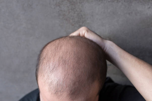 Can GFC Treatment for Hair Improve Scalp Health