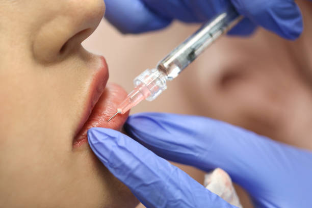 Can Lip Fillers Injection Deliver Long-Lasting Results