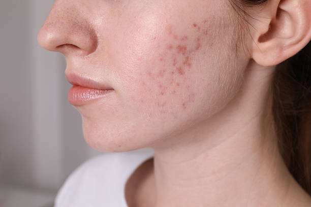 How Does Acne Treatment Help Clear Stubborn Acne