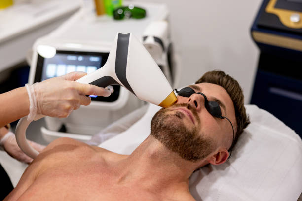 How Does Beard Laser Hair Removal Reduce Ingrown Hairs