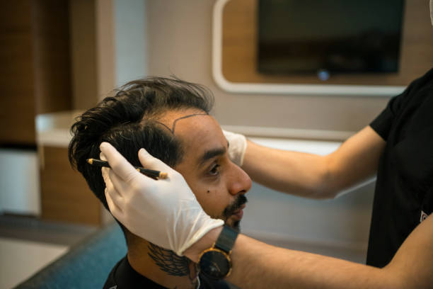How Does FUE Hair Transplant Treat Hair Loss