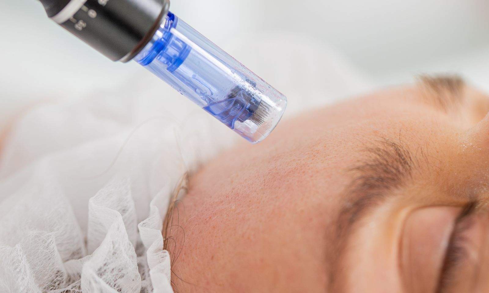 Fractional RF Micro Needling Abu Dhabi