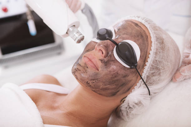 How Does Laser Carbon Peel Refresh Skin