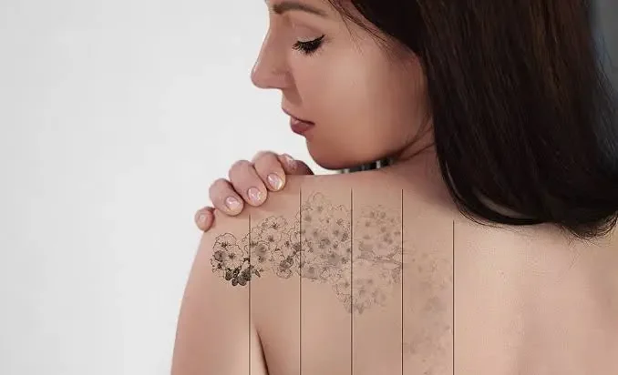 How Does Laser Tattoo Removal Reduce Ink