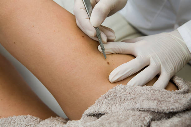 How Does Skin Lesion Removal Work