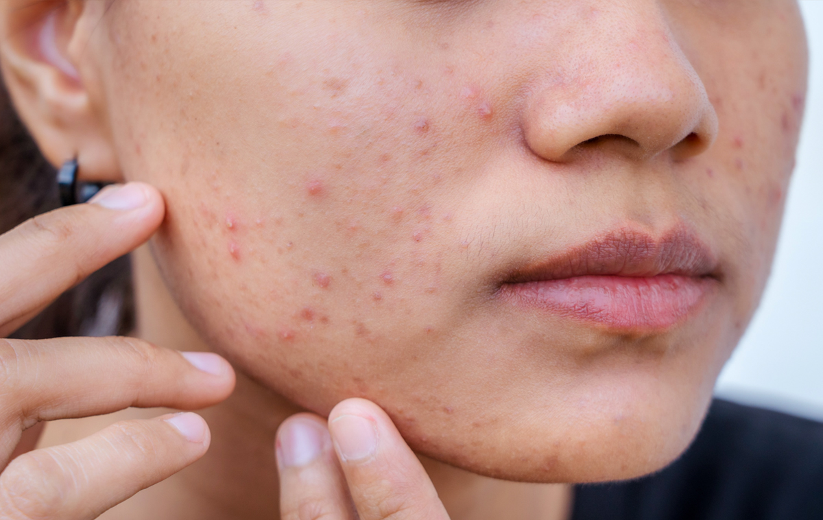 Acne Treatment in Abu Dhabi