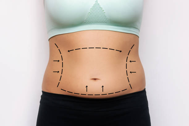 Is Liposuction a Good Choice for Body Sculpting