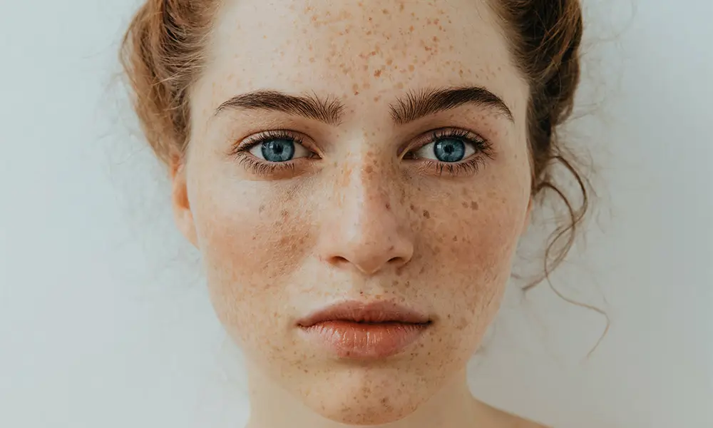 Melasma Treatment in Abu Dhabi