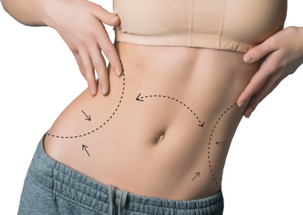 Is Tummy Tuck Right for Your Body Goals
