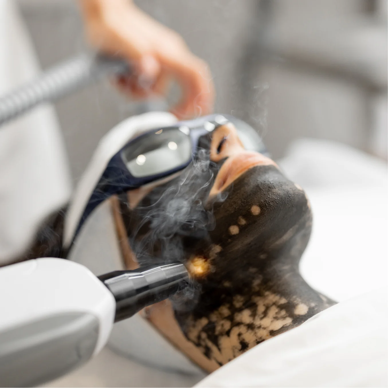 Refresh Your Skin with Laser Carbon Peel