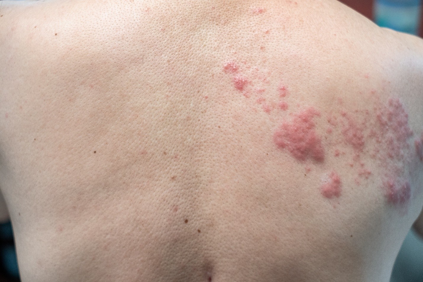Skin Diseases Treatment in Abu Dhabi
