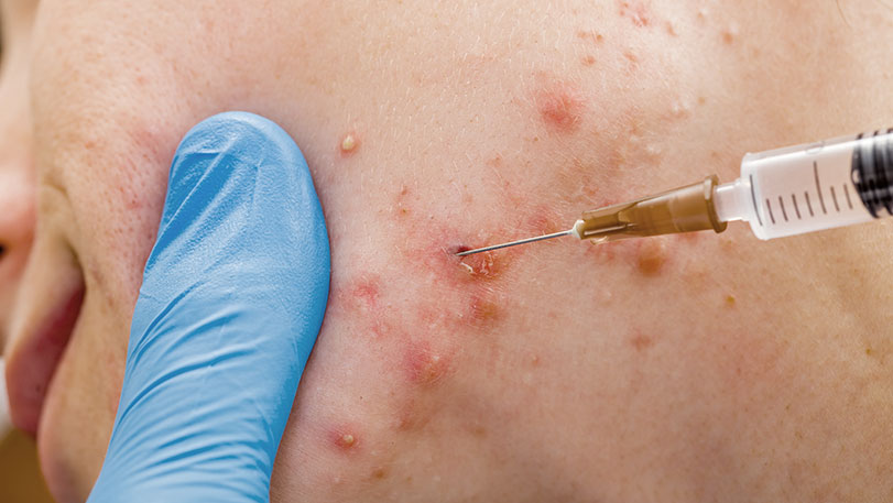 Subcision Treatment for Acne Scars in Abu Dhabi