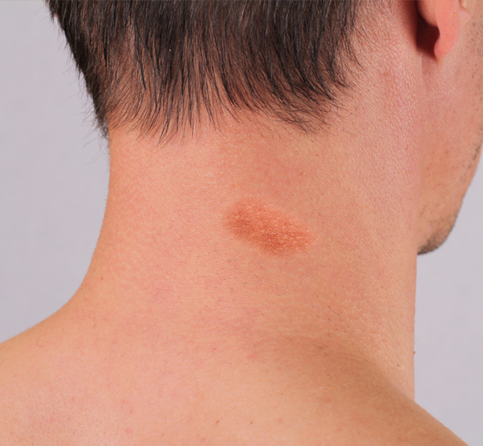 Birthmarks Removal Treatment in Abu Dhabi